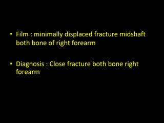 • Film : minimally displaced fracture midshaft
both bone of right forearm
• Diagnosis : Close fracture both bone right
forearm
 