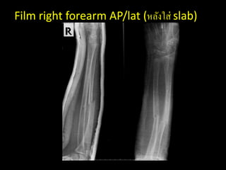 Film right forearm AP/lat (หลังใส่ slab)
 