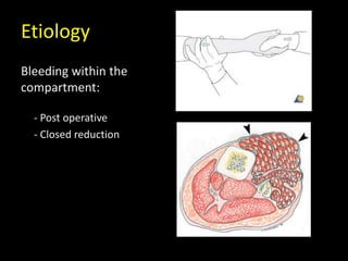 Etiology
Bleeding within the
compartment:
- Post operative
- Closed reduction
 