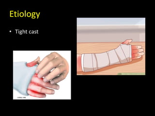Case conference compartment syndrome | PPTX