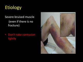 Etiology
Severe bruised muscle
(even if there is no
fracture)
• Don’t take contusion
lightly
 