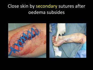 Close skin by secondary sutures after
oedema subsides
 