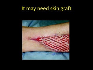 It may need skin graft
 