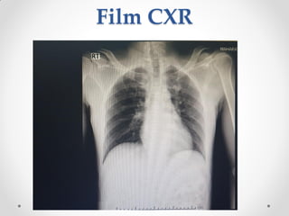 Film CXR
 