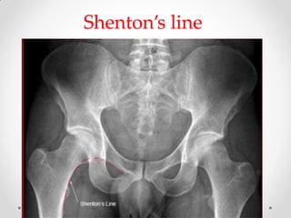 Shenton’s line
 