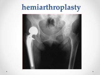 hemiarthroplasty
 