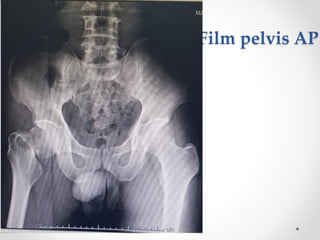 Film pelvis AP
 