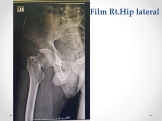 Film Rt.Hip lateral
 