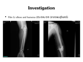 Investigation
• Film Lt elbow and humerus 25/04/59 (จากรพ.สุรินทร์)
 