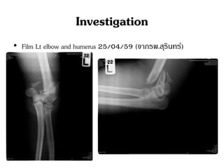 Investigation
• Film Lt elbow and humerus 25/04/59 (จากรพ.สุรินทร์)
 