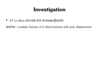 Investigation
• CT Lt elbow 25/04/59 (จากรพ.สุรินทร์)
ผลอ่าน : condylar fracture of Lt distal humerus with post. displacement
 