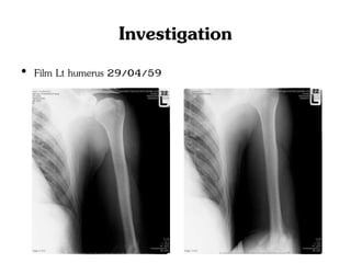 Investigation
• Film Lt humerus 29/04/59
 