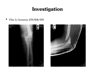 Investigation
• Film Lt humerus 29/04/59
 