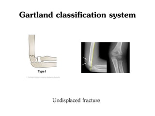 Gartland classification system
Undisplaced fracture
 
