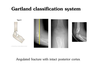 Gartland classification system
Angulated fracture with intact posterior cortex
 