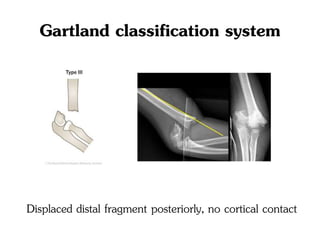 Gartland classification system
Displaced distal fragment posteriorly, no cortical contact
 