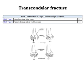 Transcondylar fracture
 