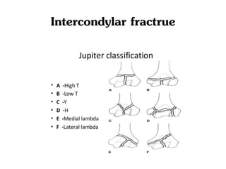 Intercondylar fractrue
 