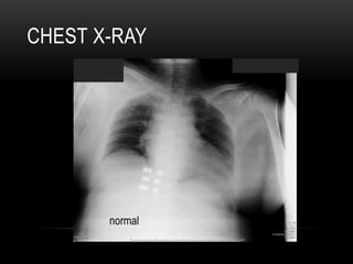 CHEST X-RAY
normal
 
