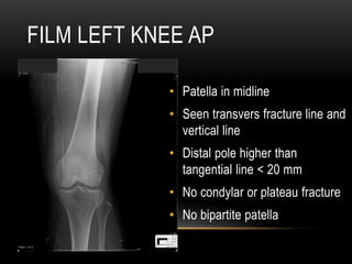 FILM LEFT KNEE AP
• Patella in midline
• Seen transvers fracture line and
vertical line
• Distal pole higher than
tangential line < 20 mm
• No condylar or plateau fracture
• No bipartite patella
 