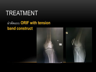 TREATMENT
ผ่าตัดแบบ ORIF with tension
band construct
 