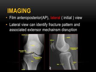 IMAGING
• Film anteroposterior(AP), lateral ( initial ) view
• Lateral view can identify fracture pattern and
associated extensor mechainsm disruption
 