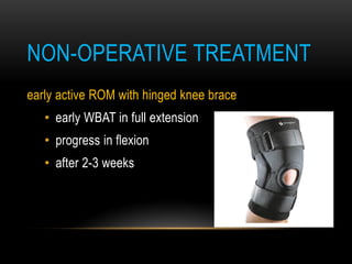 early active ROM with hinged knee brace
• early WBAT in full extension
• progress in flexion
• after 2-3 weeks
NON-OPERATIVE TREATMENT
 