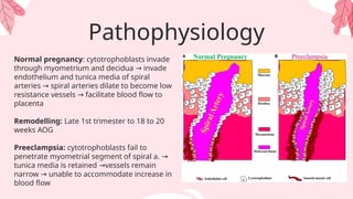 Pathophysiology
Normal pregnancy: cytotrophoblasts invade
through myometrium and decidua invade
→
endothelium and tunica media of spiral
arteries spiral arteries dilate to become low
→
resistance vessels facilitate blood flow to
→
placenta
Remodelling: Late 1st trimester to 18 to 20
weeks AOG
Preeclampsia: cytotrophoblasts fail to
penetrate myometrial segment of spiral a. →
tunica media is retained vessels remain
→
narrow unable to accommodate increase in
→
blood flow
 