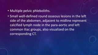 • Multiple pelvic phleboliths.
• Small well-defined round osseous lesions in the left
side of the abdomen, adjacent to midline represent
calcified lymph node in the para-aortic and left
common iliac groups, also visualized on the
corresponding CT.
 