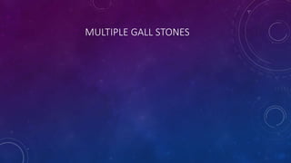 MULTIPLE GALL STONES
 