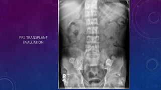 PRE TRANSPLANT
EVALUATION
 