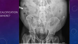 CALCIFICATION
WHERE?
 