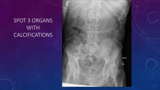 SPOT 3 ORGANS
WITH
CALCIFICATIONS
 