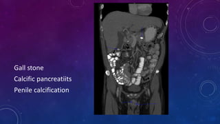Gall stone
Calcific pancreatiits
Penile calcification
 