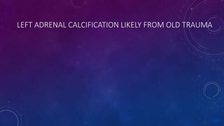 LEFT ADRENAL CALCIFICATION LIKELY FROM OLD TRAUMA
 