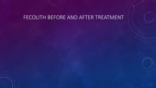FECOLITH BEFORE AND AFTER TREATMENT
 