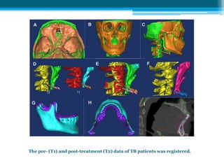 The pre- (T1) and post-treatment (T2) data of TB patients was registered.
 
