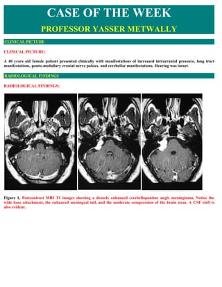 CASE OF THE WEEK
                    PROFESSOR YASSER METWALLY
CLINICAL PICTURE

CLINICAL PICTURE:

A 40 years old female patient presented clinically with manifestations of increased intracranial pressure, long tract
manifestations, ponto-medullary cranial nerve palsies. and cerebellar manifestations. Hearing was intact.

RADIOLOGICAL FINDINGS

RADIOLOGICAL FINDINGS:




Figure 1. Postcontrast MRI T1 images showing a densely enhanced cerebellopontine angle meningioma, Notice the
wide base attachment, the enhanced meningeal tail, and the moderate compression of the brain stem. A CSF cleft is
also evident.
 