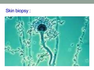 Skin biopsy :
 