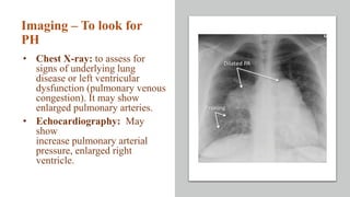Imaging – To look for
PH
• Chest X-ray: to assess for
signs of underlying lung
disease or left ventricular
dysfunction (pulmonary venous
congestion). It may show
enlarged pulmonary arteries.
• Echocardiography: May
show
increase pulmonary arterial
pressure, enlarged right
ventricle.
 