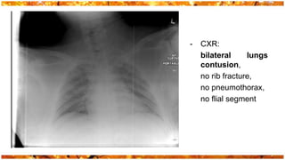 -   CXR:
    bilateral     lungs
    contusion,
    no rib fracture,
    no pneumothorax,
    no flial segment
 