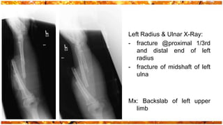 Left Radius & Ulnar X-Ray:
- fracture @proximal 1/3rd
   and distal end of left
   radius
- fracture of midshaft of left
   ulna



Mx: Backslab of left upper
  limb
 