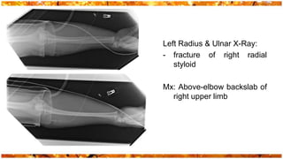 Left Radius & Ulnar X-Ray:
- fracture of right radial
   styloid

Mx: Above-elbow backslab of
  right upper limb
 