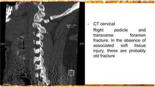 -   CT cervical
    Right       pedicle       and
    transverse          foramen
    fracture. In the absence of
    associated     soft    tissue
    injury, these are probably
    old fracture
 