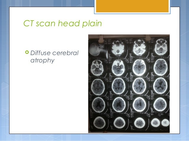 Case discussion of Alzheimer's Dementia