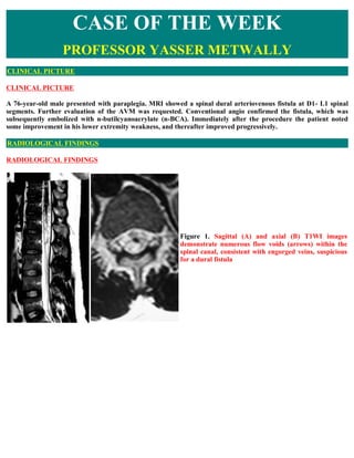 CASE OF THE WEEK
                  PROFESSOR YASSER METWALLY
CLINICAL PICTURE

CLINICAL PICTURE

A 76-year-old male presented with paraplegia. MRI showed a spinal dural arteriovenous fistula at D1- L1 spinal
segments. Further evaluation of the AVM was requested. Conventional angio confirmed the fistula, which was
subsequently embolized with n-butilcyanoacrylate (n-BCA). Immediately after the procedure the patient noted
some improvement in his lower extremity weakness, and thereafter improved progressively.

RADIOLOGICAL FINDINGS

RADIOLOGICAL FINDINGS




                                                       Figure 1. Sagittal (A) and axial (B) T1WI images
                                                       demonstrate numerous flow voids (arrows) within the
                                                       spinal canal, consistent with engorged veins, suspicious
                                                       for a dural fistula
 