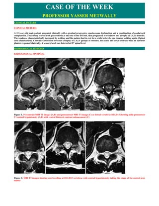 CASE OF THE WEEK
                             PROFESSOR YASSER METWALLY
CLINICAL PICTURE

CLINICAL PICTURE:

A 33 years old male patient presented clinically with a gradual progressive cauda-conus dysfunction and a combination of cauda/cord
compression. The history started with paraesthesia at the sole of the left foot, that progressed to weakness and atrophy of L4,L5 muscles.
The weakness characteristically increased by walking and the patient had to rest for a while before he can resume walking again. (Spinal
cord claudication). Clinical examination revealed atrophy of L4,L5 groups of muscles, lost knee and ankle reflexes with an extensor
planter response bilaterally. A sensory level was detected at D7 spinal level

RADIOLOGICAL FINDINGS

RADIOLOGICAL FINDINGS:




Figure 1. Precontrast MRI T1 images (A,B) and postcontrast MRI T1 image (C) at dorsal vertebrae D11,D12 showing mild precontrast
T1 central hypointensity (A,B) with central bilateral contrast enhancement (C)




Figure 2. MRI T2 images showing cord swelling at D11,D12 vertebrae with central hyperintensity taking the shape of the central grey
matter
 