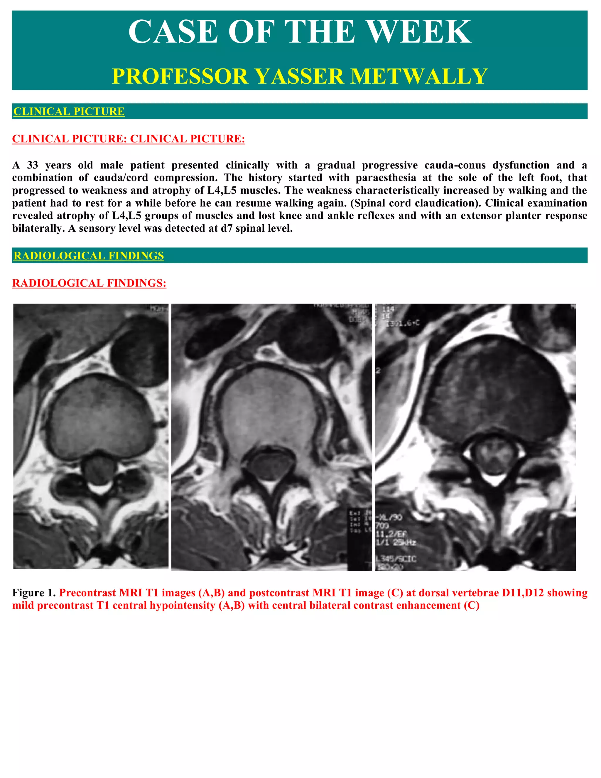 Case record...Spinal dural arteriovenous fistula with congestive ...