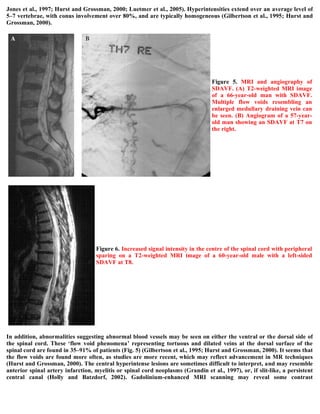 Case record...Spinal dural arteriovenous fistula with congestive ...