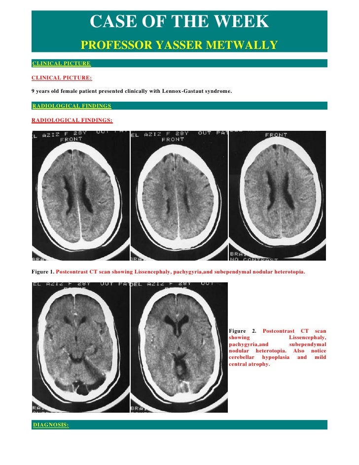 Case Record Cortical Dysplasia